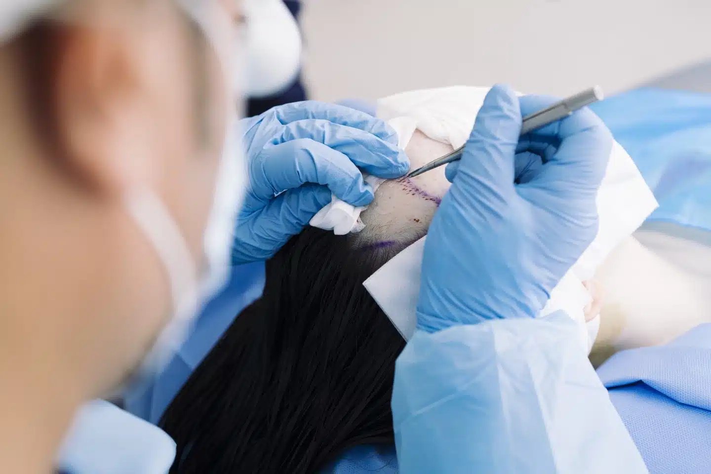 Hair transplant surgery process